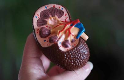 ¿Qué es el cáncer de riñón y cuáles son sus causas?