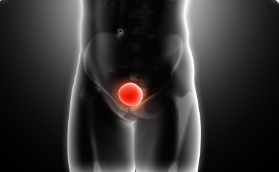 Cáncer de vejiga