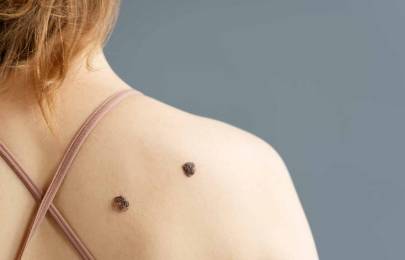 Descubre qué es un melanoma