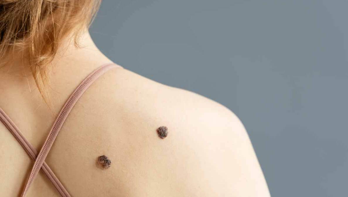 Melanoma | Cáncer de piel | Oncología - MSD Spain