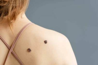 Melanoma